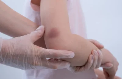 Çocuklarda kolay morluk oluşması ve uzun süren kanamalar hemofili belirtisi olabilir