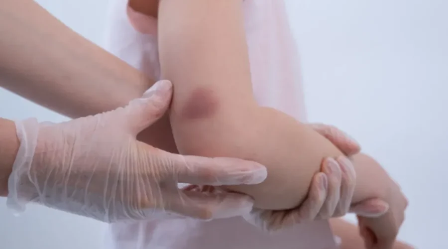 Çocuklarda kolay morluk oluşması ve uzun süren kanamalar hemofili belirtisi olabilir